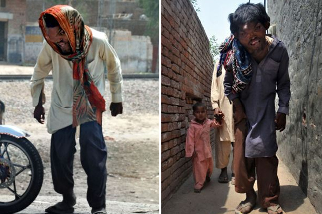  Ο παραμορφωμένος γίγαντας του Πακιστάν ψάχνει για... γυναίκα! [εικόνες]