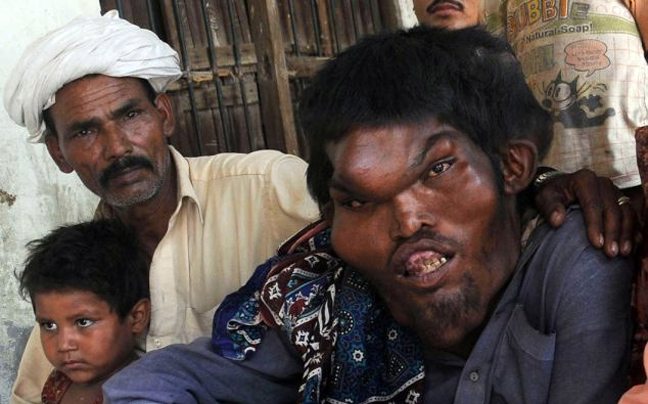  Ο παραμορφωμένος γίγαντας του Πακιστάν ψάχνει για... γυναίκα! [εικόνες]