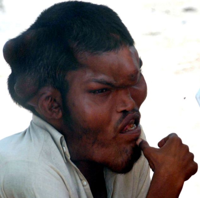  Ο παραμορφωμένος γίγαντας του Πακιστάν ψάχνει για... γυναίκα! [εικόνες]