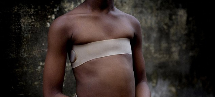 Βάρβαρο τελετουργικό: Σιδερώνουν το στήθος κοριτσιών, για να κρύψουν την εφηβεία [εικόνες]