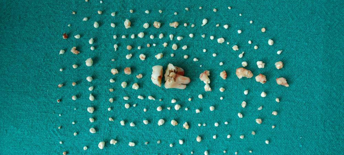 Απίστευτο περιστατικό -Βρήκαν 202 δόντια στο στόμα μιας 7χρονης 