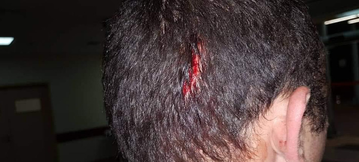 Εικόνες-σοκ: Τα τραύματα των αστυνομικών από την επίθεση των Ρομά στου Ρέντη