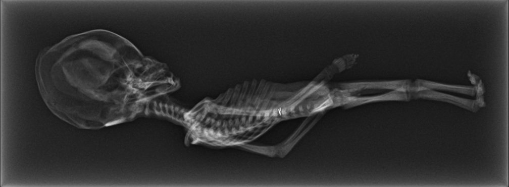 Φρίκαραν οι επιστήμονες! Βρέθηκε ανθρώπινος σκελετός «τσέπης» 15 εκ. με σπάνιες παραμορφώσεις [εικόνες] 