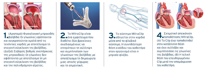 Η τεχνική MitraClip