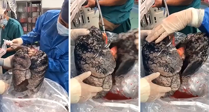 Το φυσιολογικό χρώμα των πνευμόνων του ανθρώπου είναι ένα απαλό ροζ