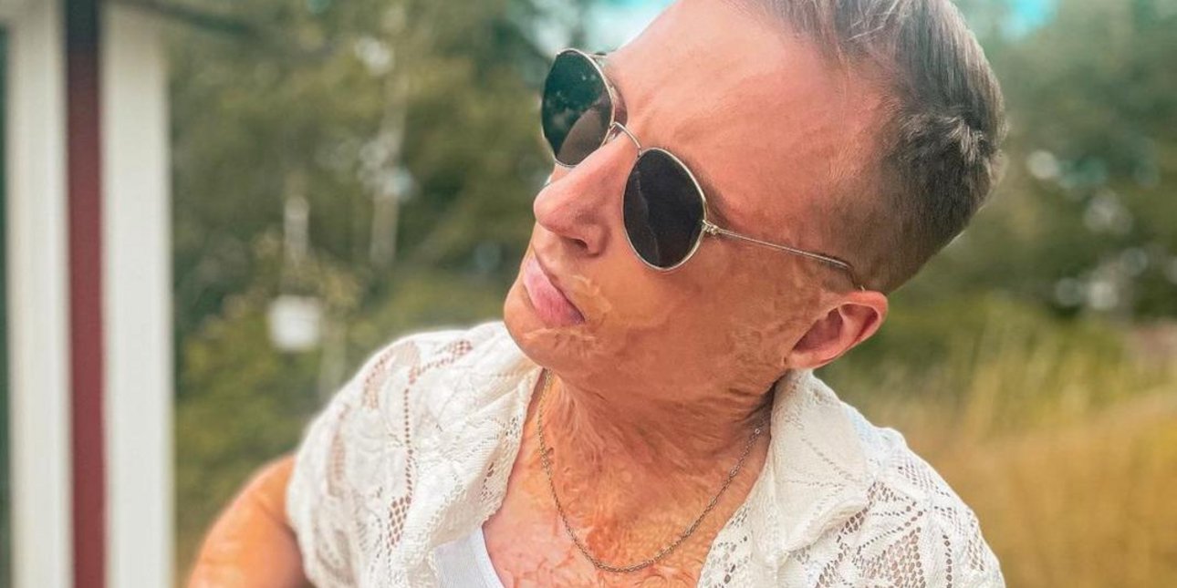 Axel Schylström O Σουηδός ποπ σταρ που έπαθε ηλεκτροπληξία στα 19 του
