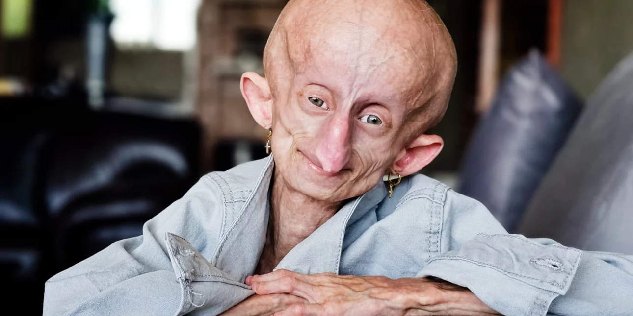 beandri progiria jean mpoufan.jpg