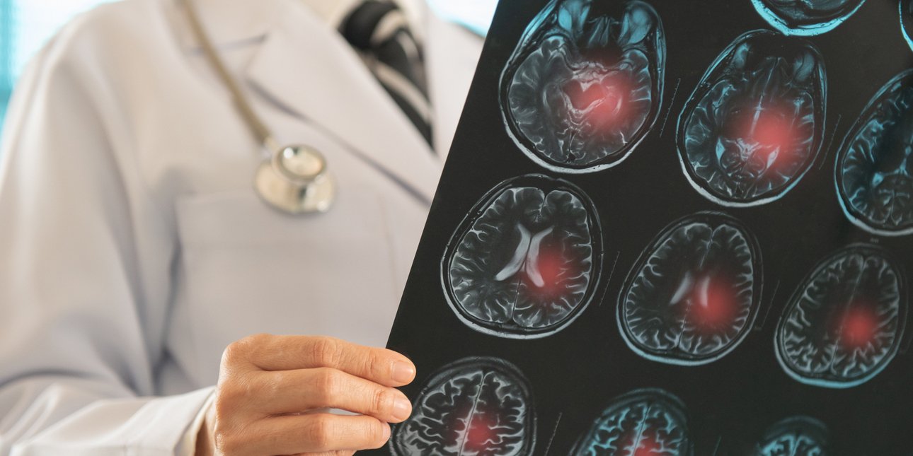 Εγκεφαλικό