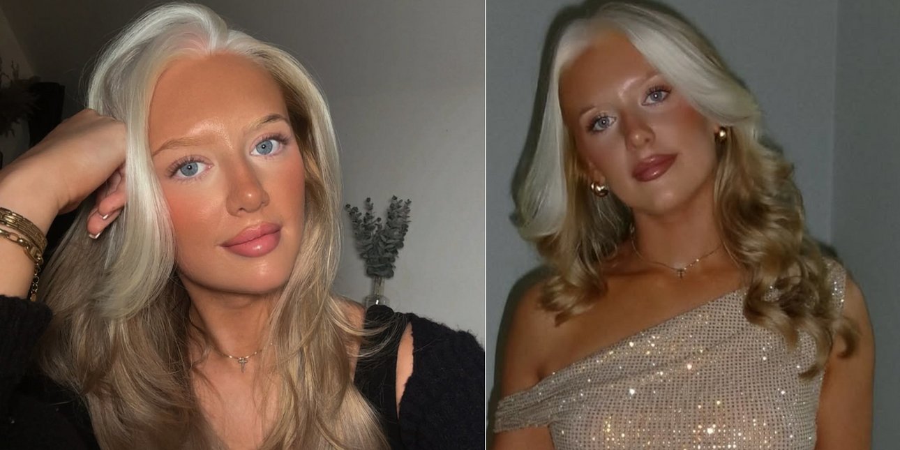 24χρονη με σπάνια γενετική πάθηση που προκαλεί άσπρα μαλλιά λέει ότι έπεσε θύμα εκφοβισμού -Την αποκαλούσαν «ασβό»