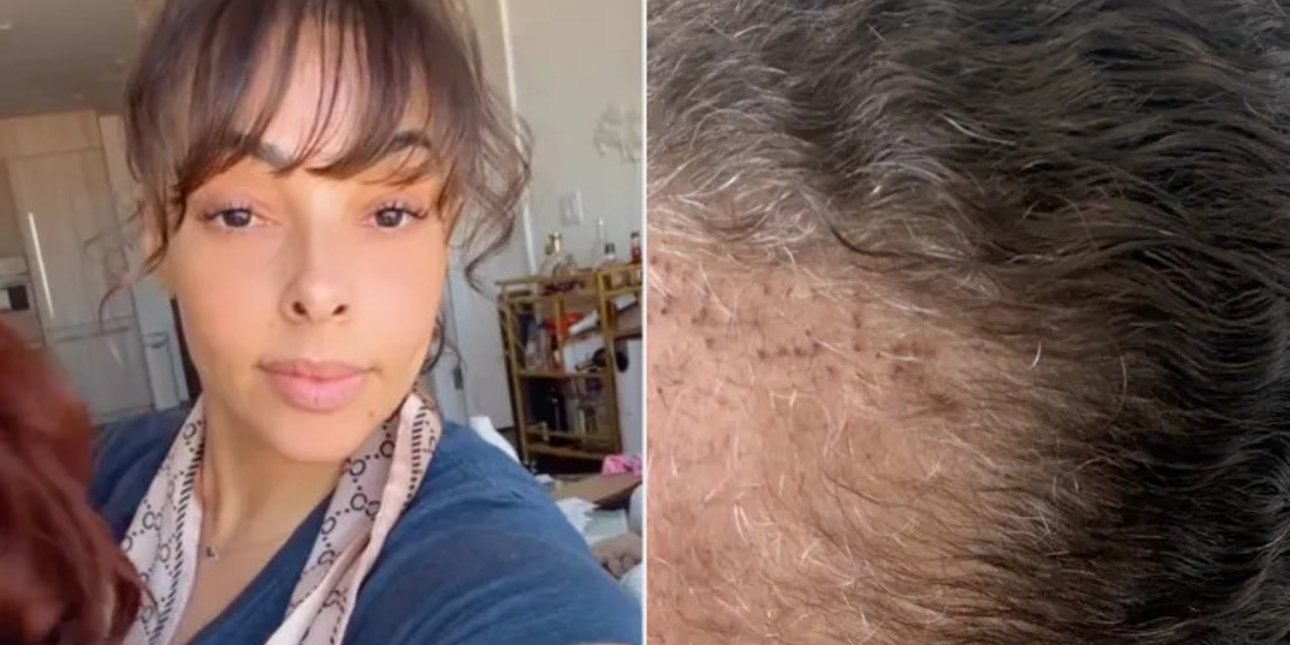 Εκανε μεταμόσχευση μαλλιών και την παρενέργεια αυτή δεν την είχε ξαναδεί ούτε ο χειρουργός της