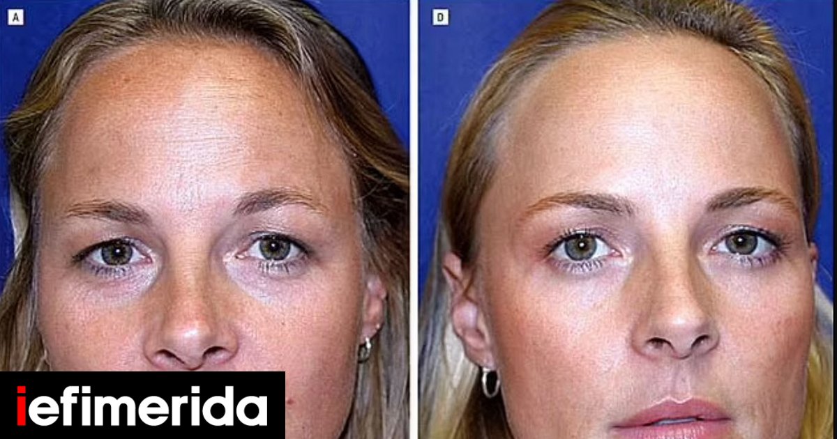 One twin used Botox regularly and the other did not – how is she doing today, years later?