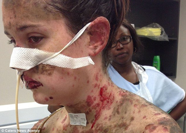 Kάηκε το δέρμα της από μέσα προς τα έξω από λάθος φάρμακο -Συγκλονίζει η 19χρονη καλλονή [εικόνες] | iefimerida.gr 3