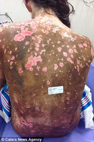 Kάηκε το δέρμα της από μέσα προς τα έξω από λάθος φάρμακο -Συγκλονίζει η 19χρονη καλλονή [εικόνες] | iefimerida.gr 1