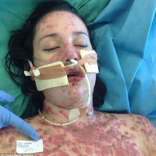 Kάηκε το δέρμα της από μέσα προς τα έξω από λάθος φάρμακο -Συγκλονίζει η 19χρονη καλλονή [εικόνες] | iefimerida.gr 0