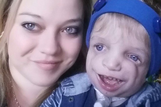 O «σούπερ ήρωας» ενός δίχρονου με δυσμορφία προσώπου –Ενας άνδρας με την ίδια ασθένεια [εικόνες] | iefimerida.gr 1