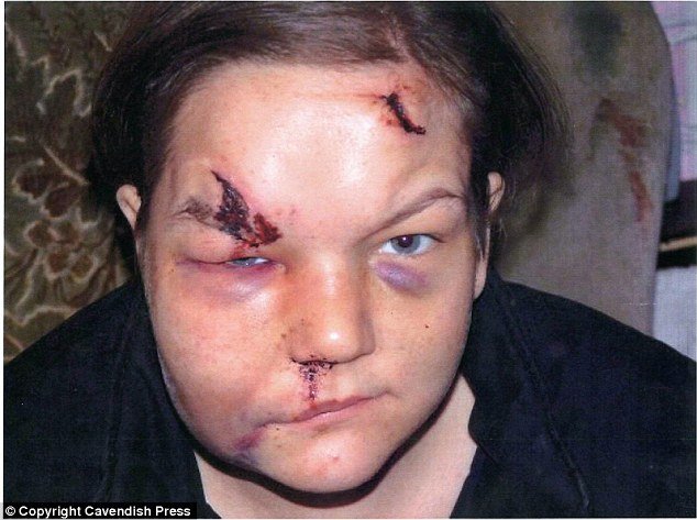 Η φρίκη των ναρκωτικών -Η παραμόρφωση νεαρής από χρήση ουσίας, που σόκαρε [εικόνες] | iefimerida.gr 0