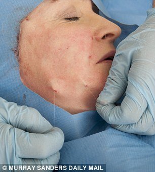 Το νέο τύπου λίφτινγκ που κάνει θραύση: Σφίγγουν το δέρμα με νήματα -Χωρίς τομές, χωρίς μεγάλο κόστος [εικόνες] | iefimerida.gr 4