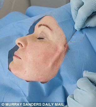 Το νέο τύπου λίφτινγκ που κάνει θραύση: Σφίγγουν το δέρμα με νήματα -Χωρίς τομές, χωρίς μεγάλο κόστος [εικόνες] | iefimerida.gr 5