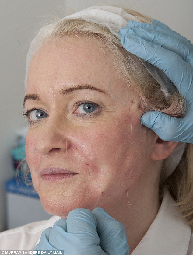 Το νέο τύπου λίφτινγκ που κάνει θραύση: Σφίγγουν το δέρμα με νήματα -Χωρίς τομές, χωρίς μεγάλο κόστος [εικόνες] | iefimerida.gr 6