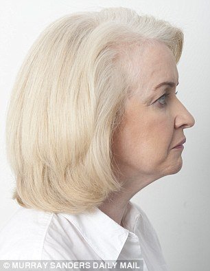 Το νέο τύπου λίφτινγκ που κάνει θραύση: Σφίγγουν το δέρμα με νήματα -Χωρίς τομές, χωρίς μεγάλο κόστος [εικόνες] | iefimerida.gr 2