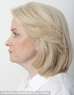 Το νέο τύπου λίφτινγκ που κάνει θραύση: Σφίγγουν το δέρμα με νήματα -Χωρίς τομές, χωρίς μεγάλο κόστος [εικόνες] | iefimerida.gr 3