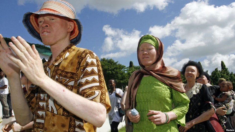 Αλμπίνοι, οι μαύροι με το λευκό δέρμα: Τους κόβουν τα χέρια και τα πωλούν για... καλή τύχη [εικόνες] | iefimerida.gr 10