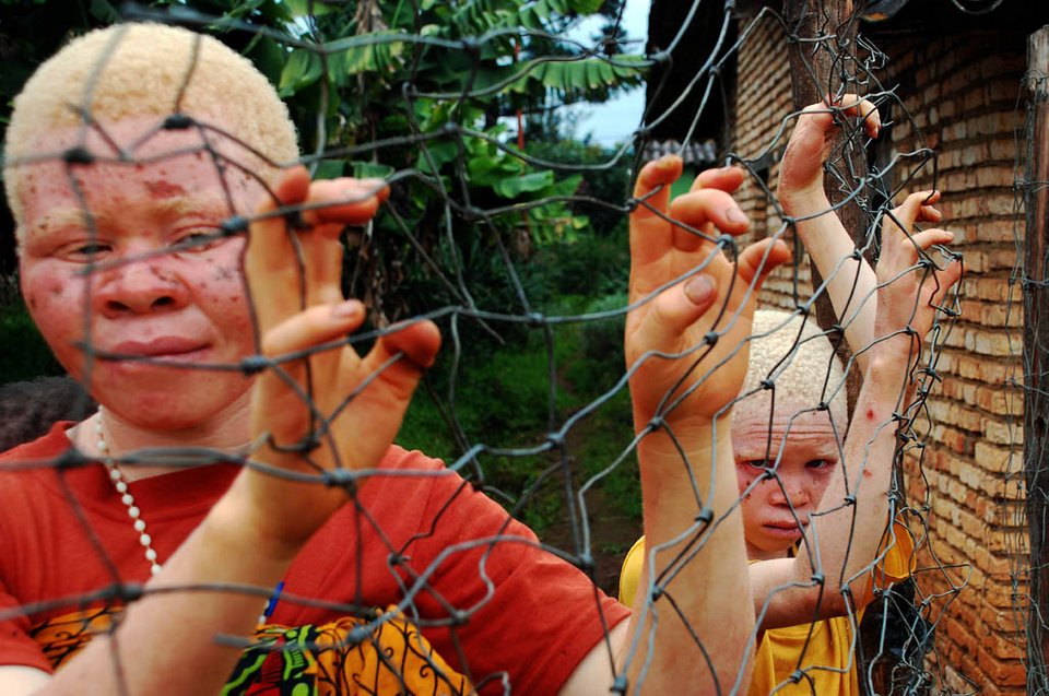 Αλμπίνοι, οι μαύροι με το λευκό δέρμα: Τους κόβουν τα χέρια και τα πωλούν για... καλή τύχη [εικόνες] | iefimerida.gr 9