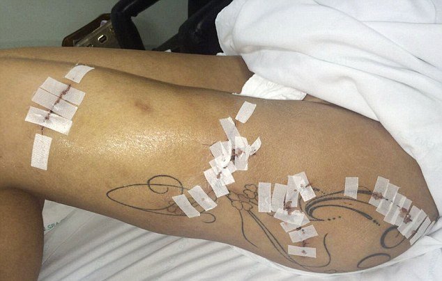 H Mις Bumbum έπαθε σηπτικό σοκ από εμφυτεύματα στα οπίσθια [εικόνες] | iefimerida.gr 2