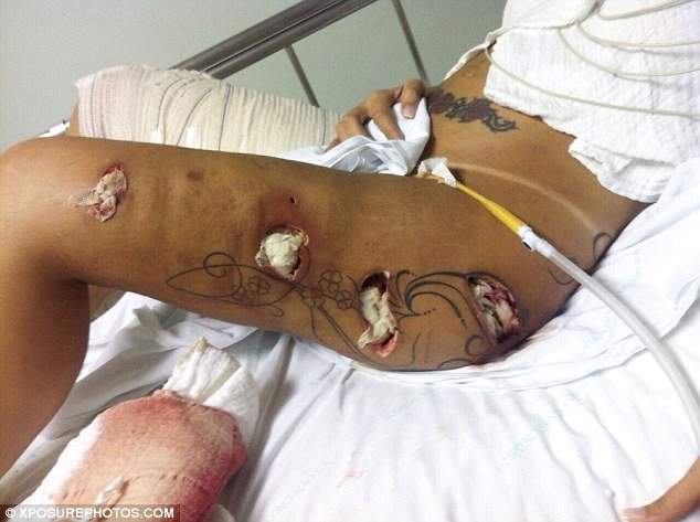 H Mις Bumbum έπαθε σηπτικό σοκ από εμφυτεύματα στα οπίσθια [εικόνες] | iefimerida.gr 1