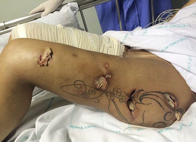 H Mις Bumbum έπαθε σηπτικό σοκ από εμφυτεύματα στα οπίσθια [εικόνες] | iefimerida.gr 3