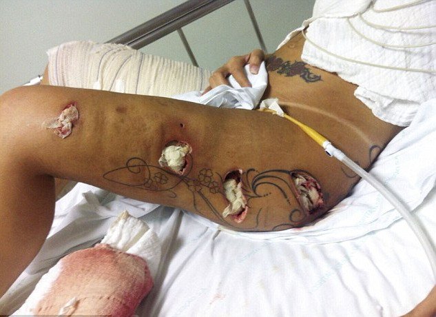 H Mις Bumbum έπαθε σηπτικό σοκ από εμφυτεύματα στα οπίσθια [εικόνες] | iefimerida.gr 4