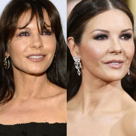 20 πασίγνωστες ηθοποιοί, τραγουδίστριες, παρουσιάστριες πριν και μετά τις πλαστικές [εικόνες] | iefimerida.gr 18