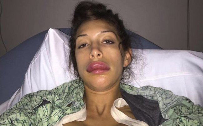 Γυναίκα «παπί»-Διάσημη καλλονή παραμορφώθηκε τελείως από αποτυχημένη πλαστική [εικόνες] | iefimerida.gr 1