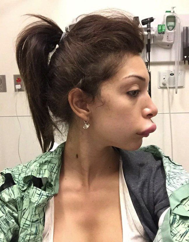 Γυναίκα «παπί»-Διάσημη καλλονή παραμορφώθηκε τελείως από αποτυχημένη πλαστική [εικόνες] | iefimerida.gr 0