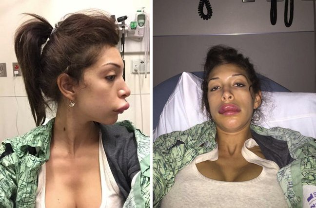 Γυναίκα «παπί»-Διάσημη καλλονή παραμορφώθηκε τελείως από αποτυχημένη πλαστική [εικόνες] | iefimerida.gr 2