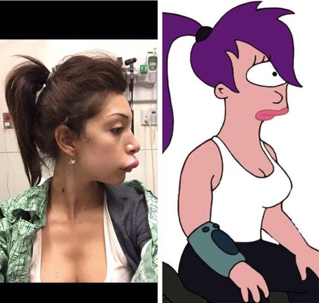 Γυναίκα «παπί»-Διάσημη καλλονή παραμορφώθηκε τελείως από αποτυχημένη πλαστική [εικόνες] | iefimerida.gr 3