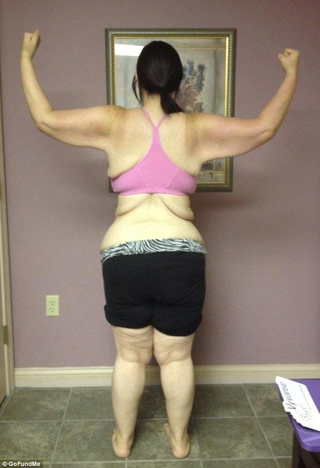 Ετσι γίνεται το σώμα μετά από μεγάλη απώλεια κιλών -Η 19χρονη που ζύγιζε 188 κιλά και έχασε 95 [εικόνες] | iefimerida.gr 1