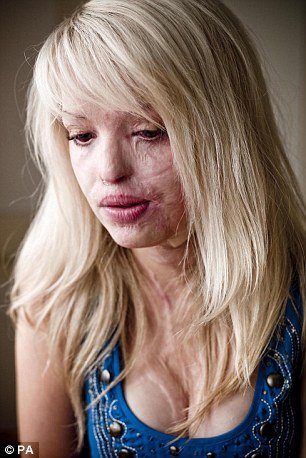 Η 30χρονη καλλονή που δεν το έβαλε κάτω: Στα 24 τής κατέστρεψαν το πρόσωπο με οξύ -Σήμερα είναι παρουσιάστρια εκπομπής [εικόνες] | iefimerida.gr 3