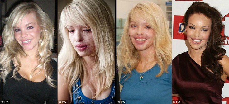 Η 30χρονη καλλονή που δεν το έβαλε κάτω: Στα 24 τής κατέστρεψαν το πρόσωπο με οξύ -Σήμερα είναι παρουσιάστρια εκπομπής [εικόνες] | iefimerida.gr 13