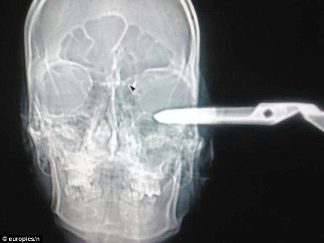 Αναυδοι οι γιατροί: Εχω ένα προβληματάκι, ένα ψαλίδι καρφωμένο στο μάτι [εικόνες] | iefimerida.gr 1