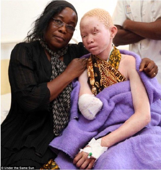 Αλμπίνοι, οι μαύροι με το λευκό δέρμα: Τους κόβουν τα χέρια και τα πωλούν για... καλή τύχη [εικόνες] | iefimerida.gr 2