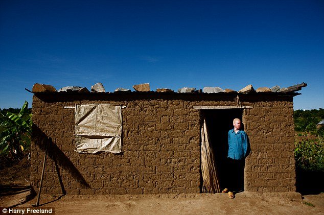 Αλμπίνοι, οι μαύροι με το λευκό δέρμα: Τους κόβουν τα χέρια και τα πωλούν για... καλή τύχη [εικόνες] | iefimerida.gr 4