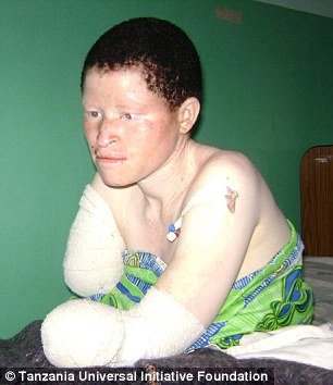 Αλμπίνοι, οι μαύροι με το λευκό δέρμα: Τους κόβουν τα χέρια και τα πωλούν για... καλή τύχη [εικόνες] | iefimerida.gr 1