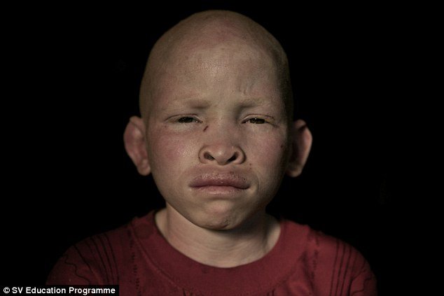 Αλμπίνοι, οι μαύροι με το λευκό δέρμα: Τους κόβουν τα χέρια και τα πωλούν για... καλή τύχη [εικόνες] | iefimerida.gr 3