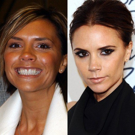 20 πασίγνωστες ηθοποιοί, τραγουδίστριες, παρουσιάστριες πριν και μετά τις πλαστικές [εικόνες] | iefimerida.gr 19