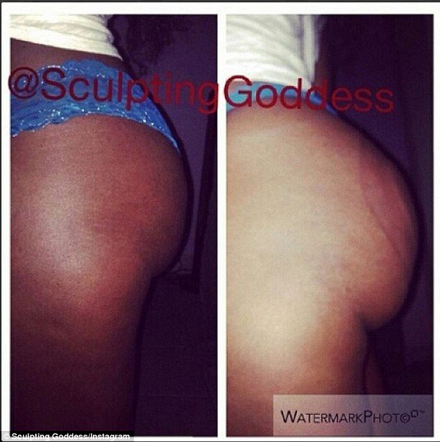 Eτσι φούσκωσε τα οπίσθιά της η Καρντάσιαν: Η νέα μέθοδος με τις βεντούζες που κοστίζει 50 ευρώ [εικόνες] | iefimerida.gr 2