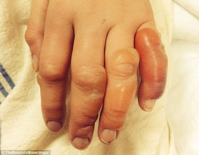 Επαθε χιονίστρες στα δάχτυλα όταν έπεσε ξερή από μεθύσι έξω από μπαρ [εικόνες] | iefimerida.gr 2