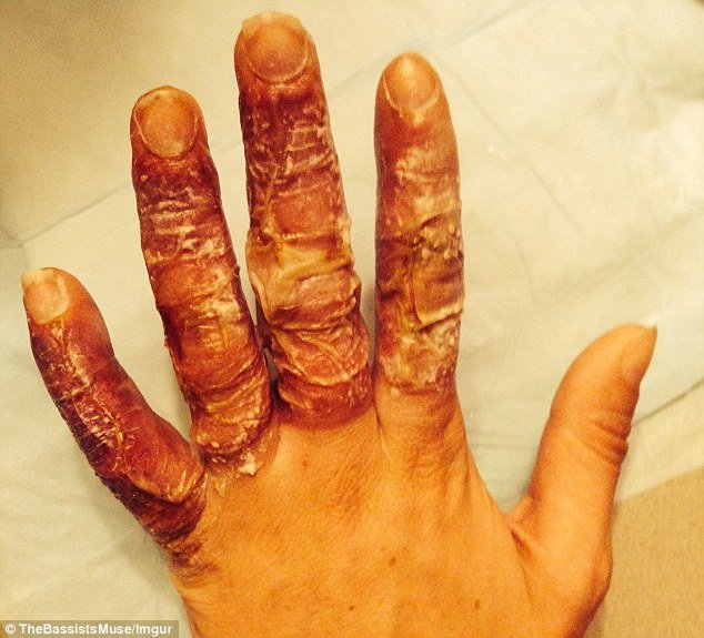 Επαθε χιονίστρες στα δάχτυλα όταν έπεσε ξερή από μεθύσι έξω από μπαρ [εικόνες] | iefimerida.gr 3