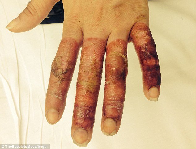 Επαθε χιονίστρες στα δάχτυλα όταν έπεσε ξερή από μεθύσι έξω από μπαρ [εικόνες] | iefimerida.gr 4