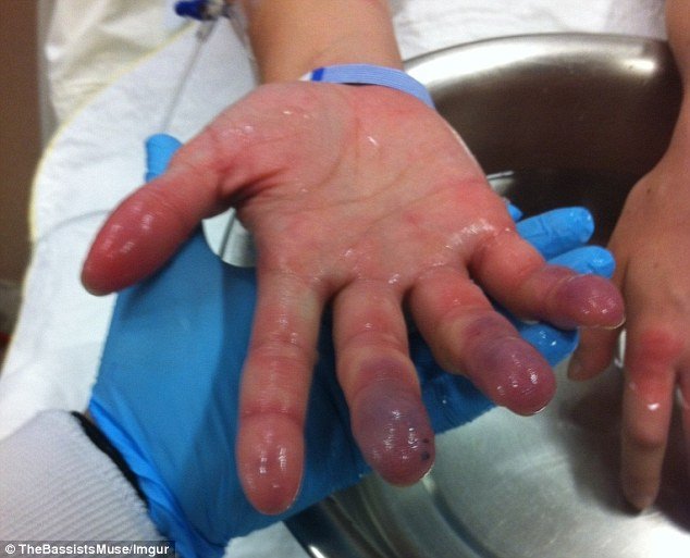 Επαθε χιονίστρες στα δάχτυλα όταν έπεσε ξερή από μεθύσι έξω από μπαρ [εικόνες] | iefimerida.gr 5